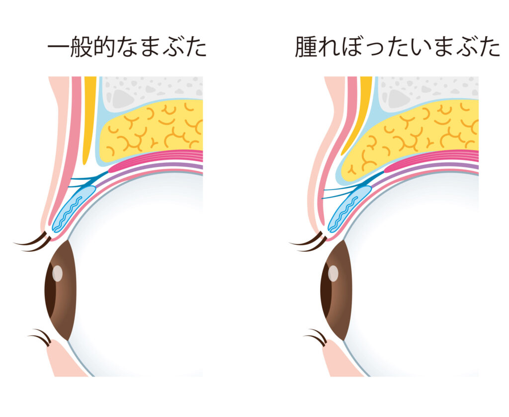 一般的なまぶたと腫れているまぶた