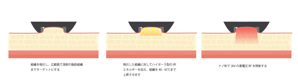 組織を吸引し、広範囲で深部の脂肪組織までターゲットにする 吸引した組織に対してハイボーラ型のRFエネルギーを加え、組織を40~43℃まで上昇させます ナノ秒で2kvの高電圧RFを照射する
