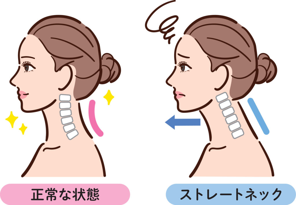 正常な状態とストレートネックの女性