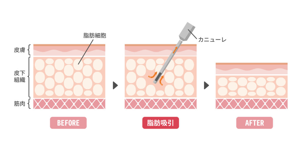 脂肪吸引