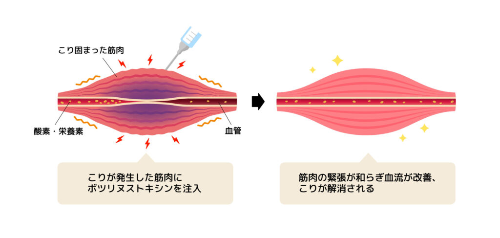 ボトックス注射
