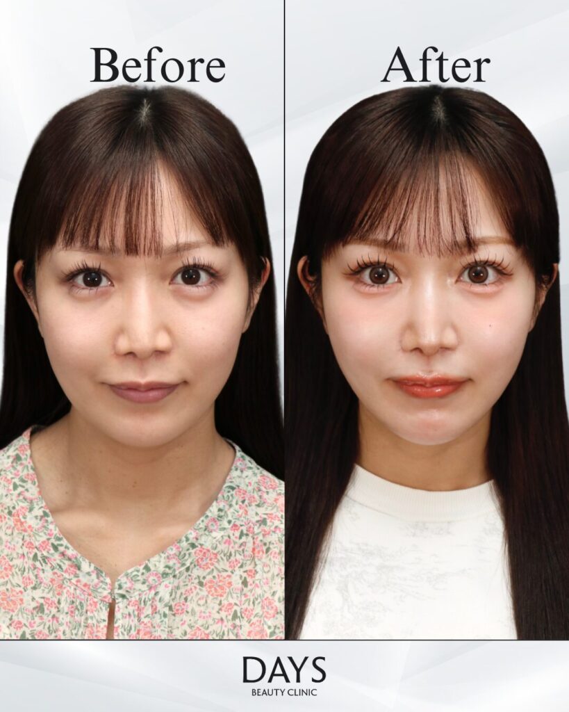 小顔　症例　20代女性