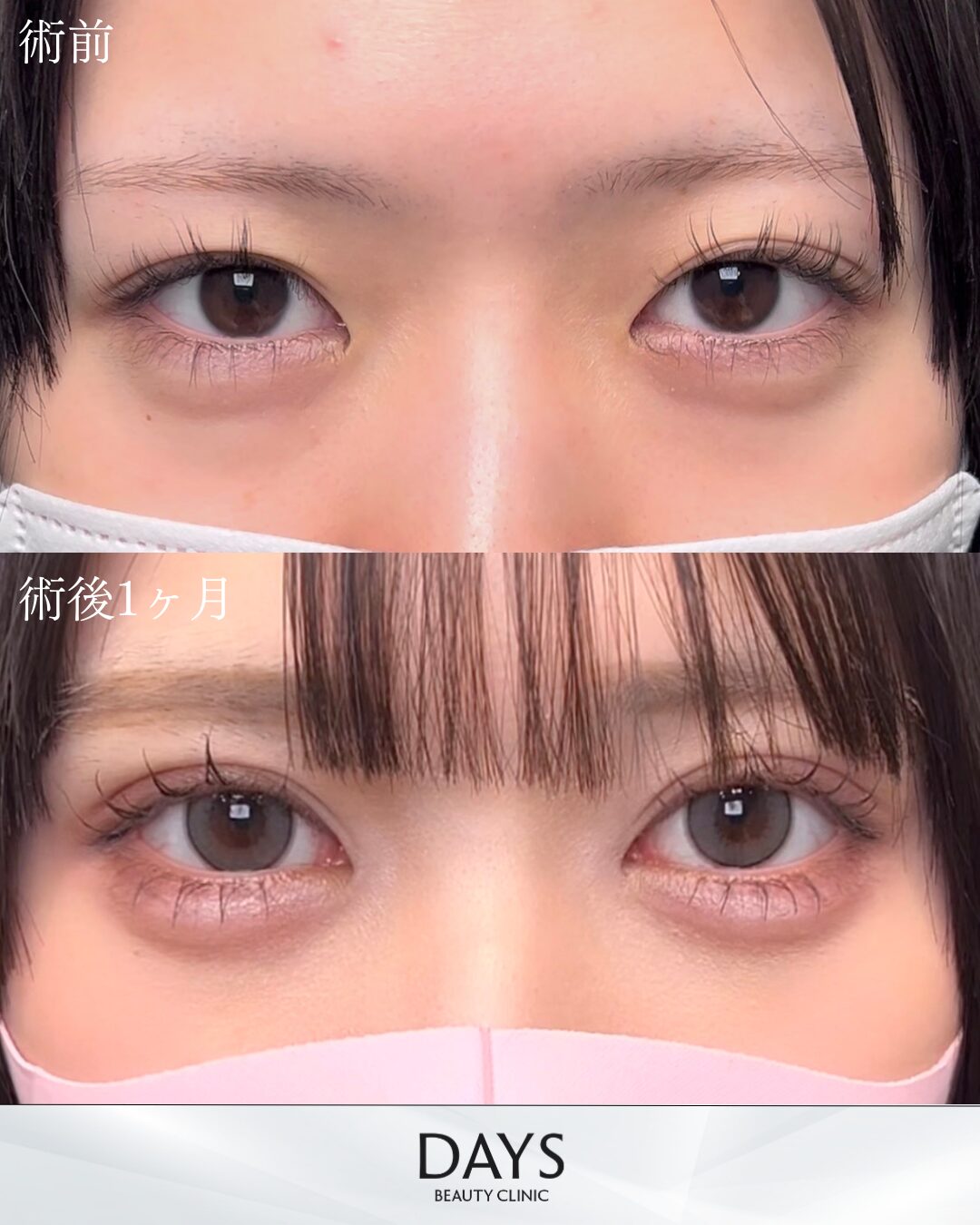 原田二重HP症例-1