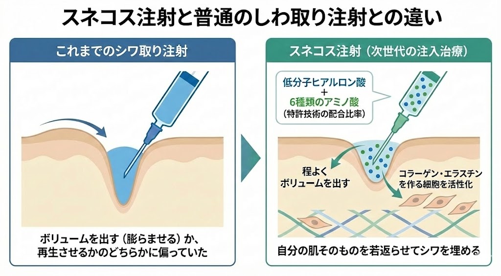 スネコス注射と普通のしわ取り注射との違い