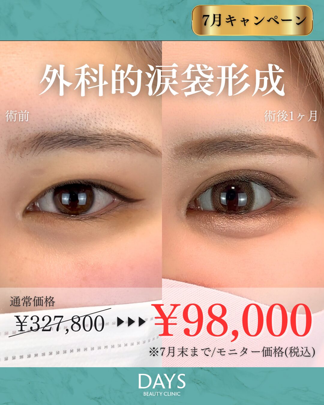 涙袋形成 岩井 2607