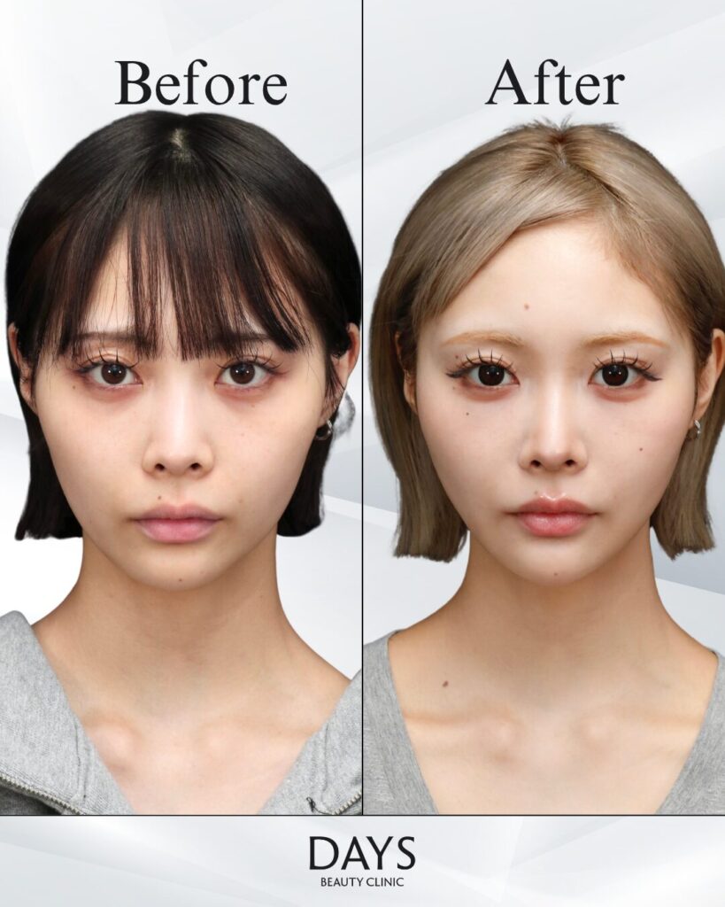 小顔症例　20代　女性