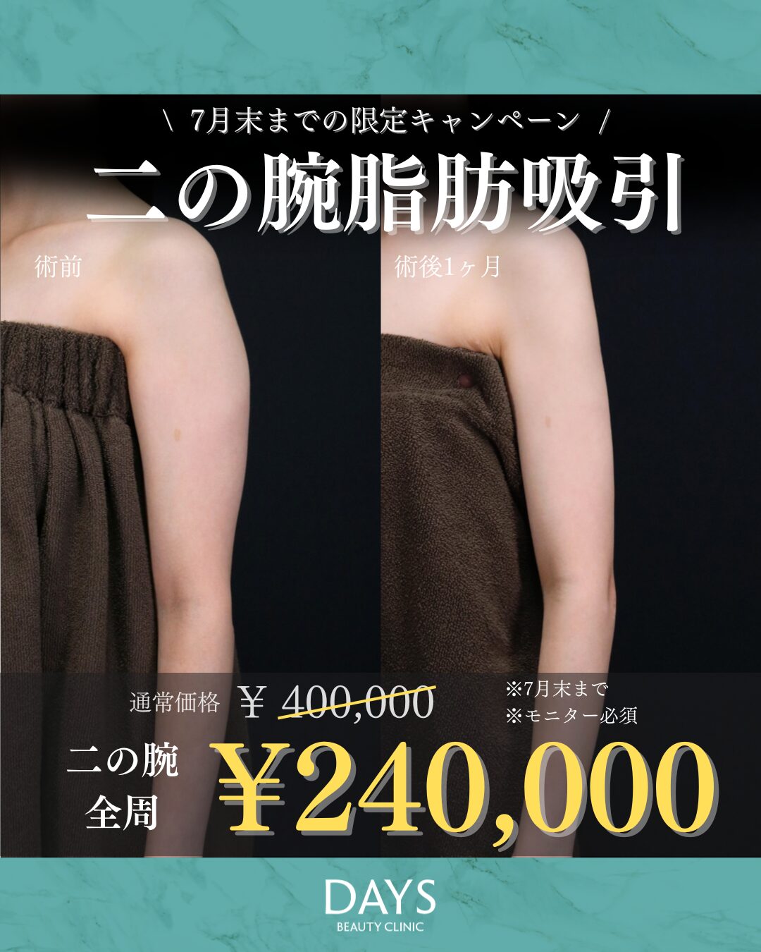 二の腕脂肪吸引 須見 2607