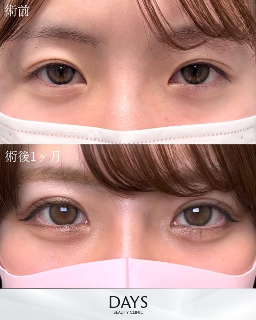 二重埋没　症例　20代女性