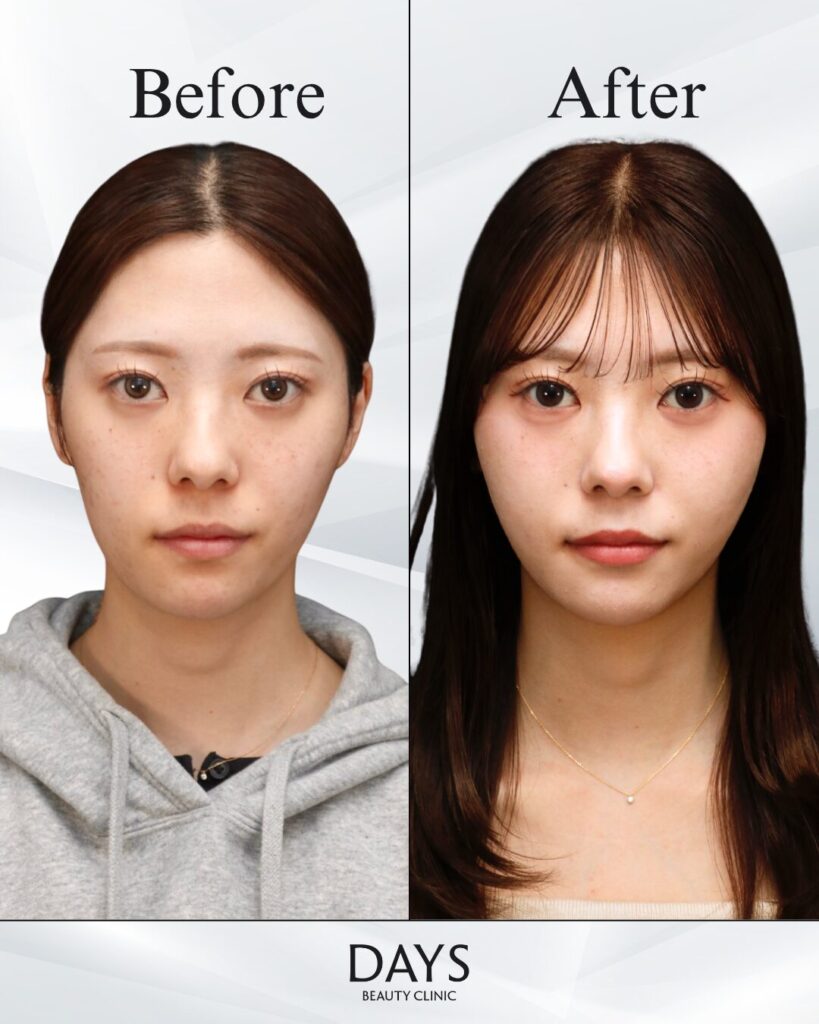 小顔症例　20代　女性